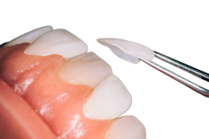 applicazione faccette dentali Milano | Fiocchi