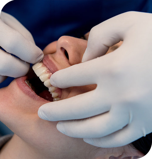 applicazione faccette dentali estetiche | Dott. Fiocchi