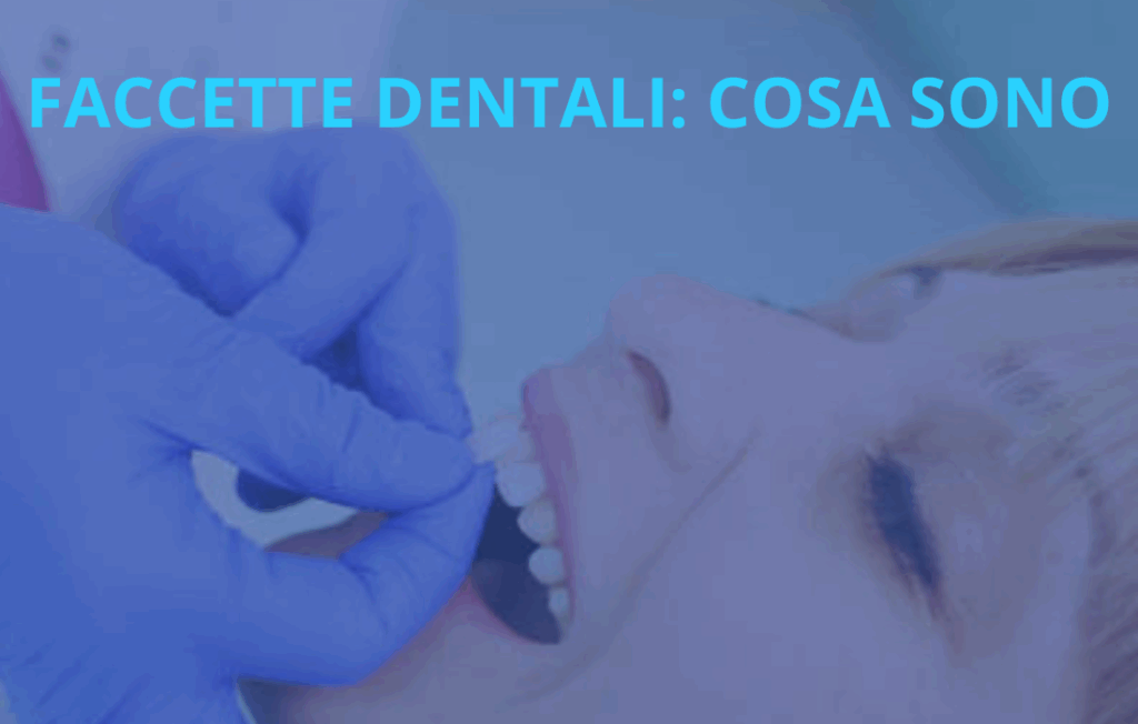 FACCETTE DENTALI COSA SONO