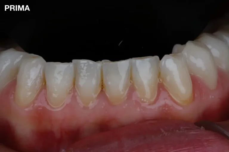 Denti prima e dopo 19 denti prima e dopo