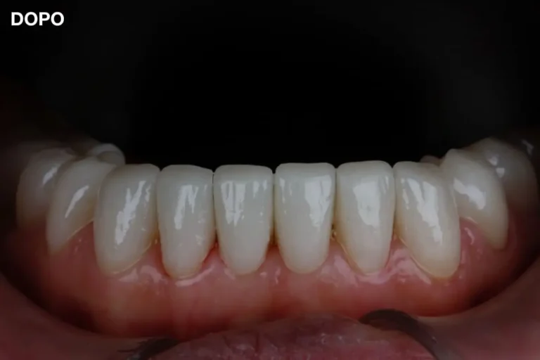 Denti prima e dopo 20 denti prima e dopo