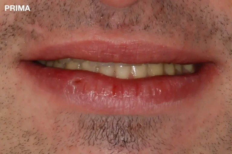 Denti prima e dopo 21 denti prima e dopo