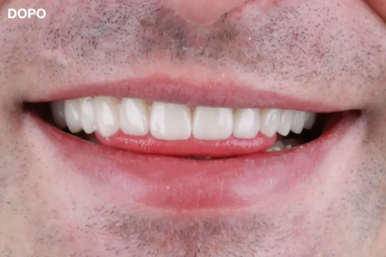 Denti prima e dopo 22 denti prima e dopo