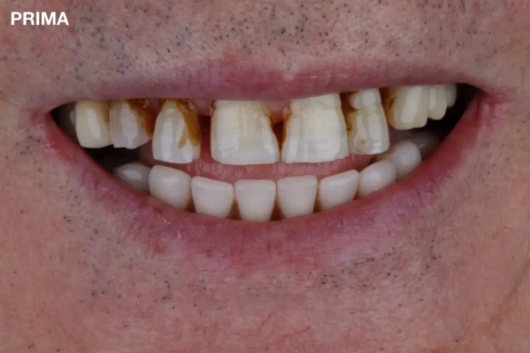 Denti prima e dopo 23 denti prima e dopo