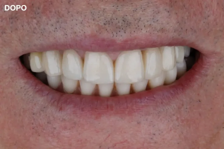 Denti prima e dopo 24 denti prima e dopo