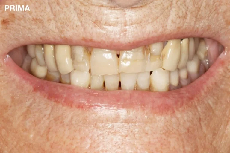 Denti prima e dopo 25 denti prima e dopo
