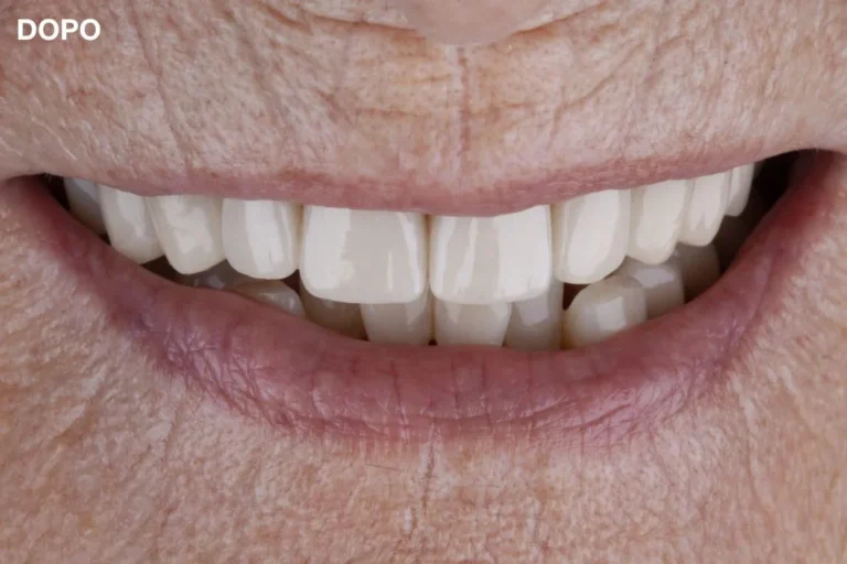Denti prima e dopo 26 denti prima e dopo