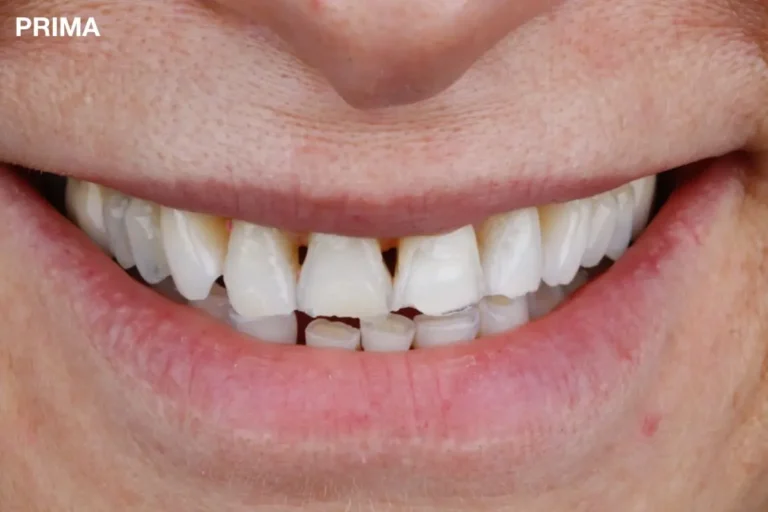 Denti prima e dopo 27 denti prima e dopo