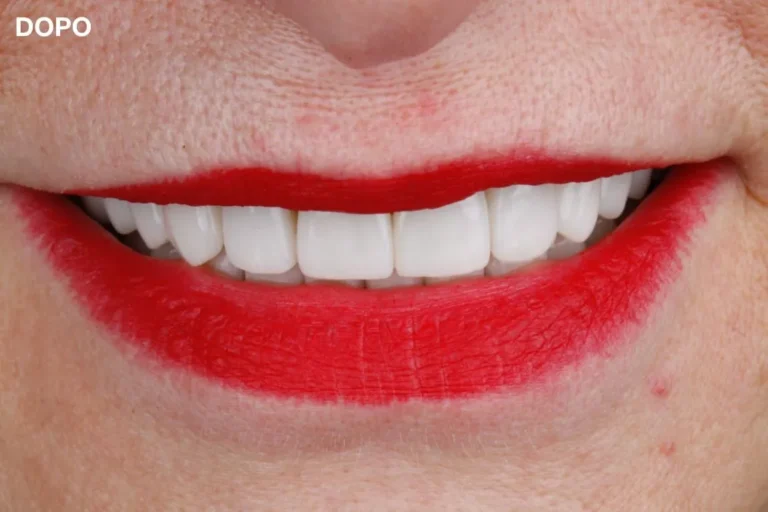 Denti prima e dopo 28 denti prima e dopo