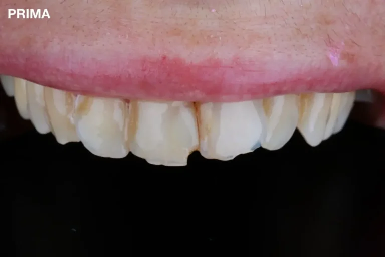 Denti prima e dopo 29 denti prima e dopo