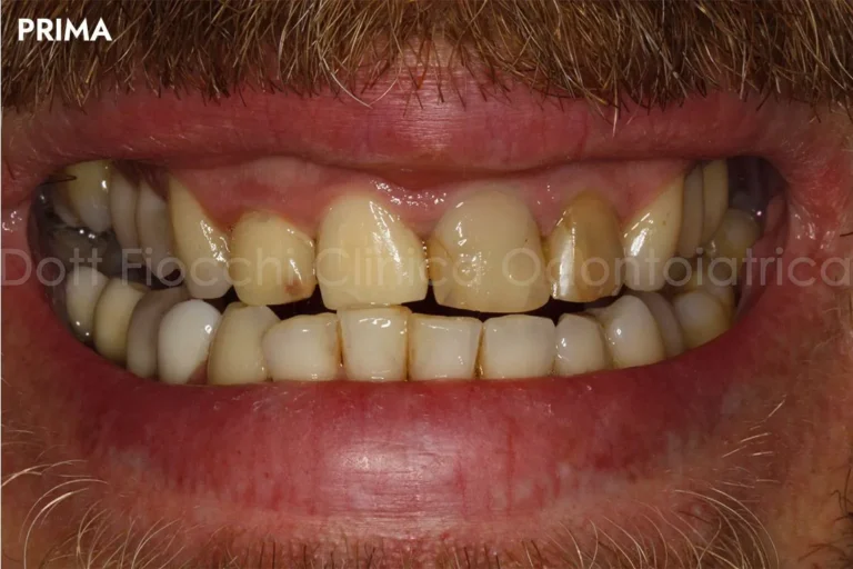 Denti prima e dopo 1 denti prima e dopo