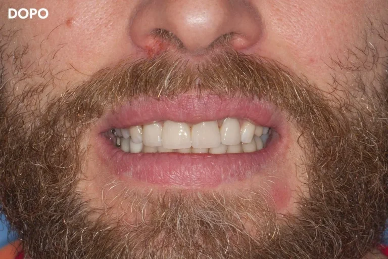 Denti prima e dopo 2 denti prima e dopo