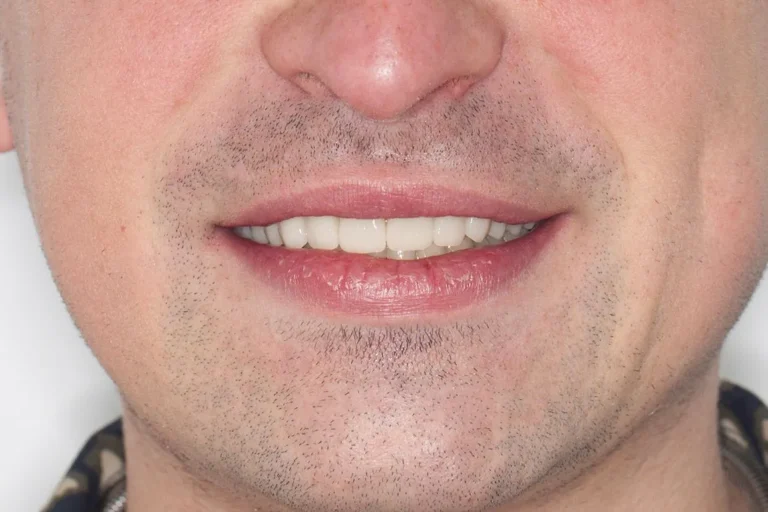 Denti prima e dopo 4 denti prima e dopo