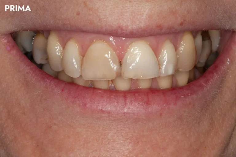 Denti prima e dopo 5 denti prima e dopo
