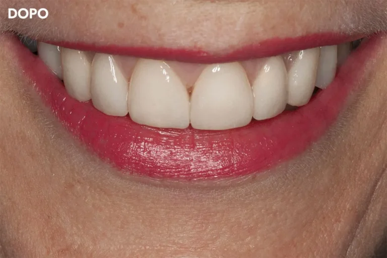 Denti prima e dopo 6 denti prima e dopo