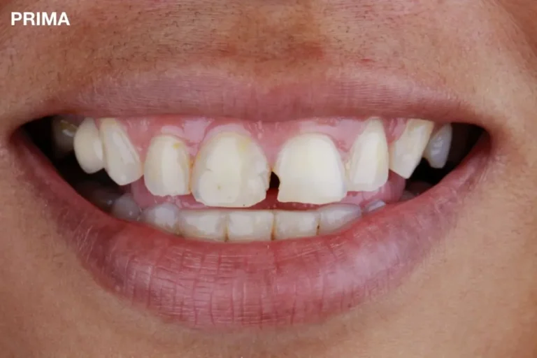 Denti prima e dopo 7 denti prima e dopo