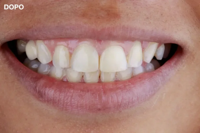 Denti prima e dopo 8 denti prima e dopo