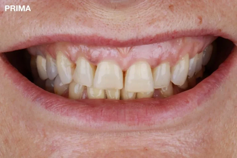 Denti prima e dopo 9 denti prima e dopo