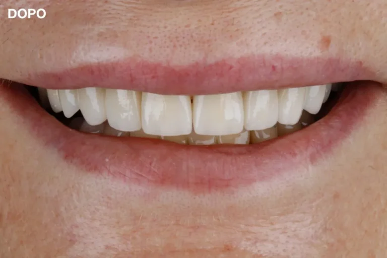 Denti prima e dopo 10 denti prima e dopo