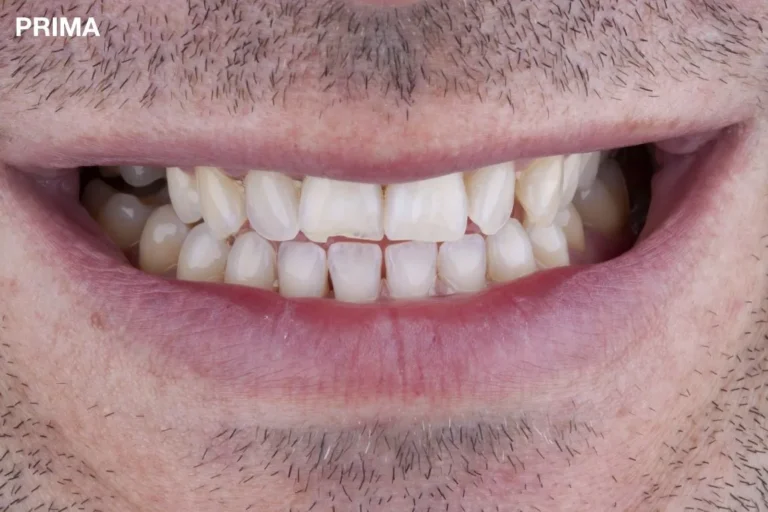 Denti prima e dopo 11 denti prima e dopo