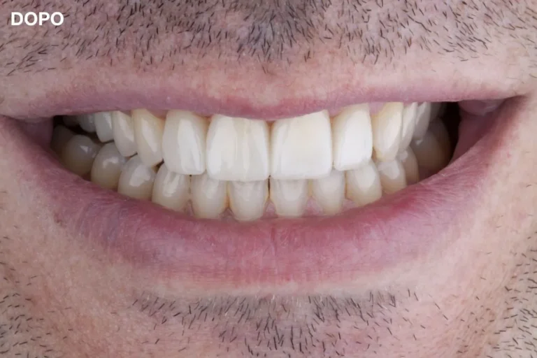 Denti prima e dopo 12 denti prima e dopo