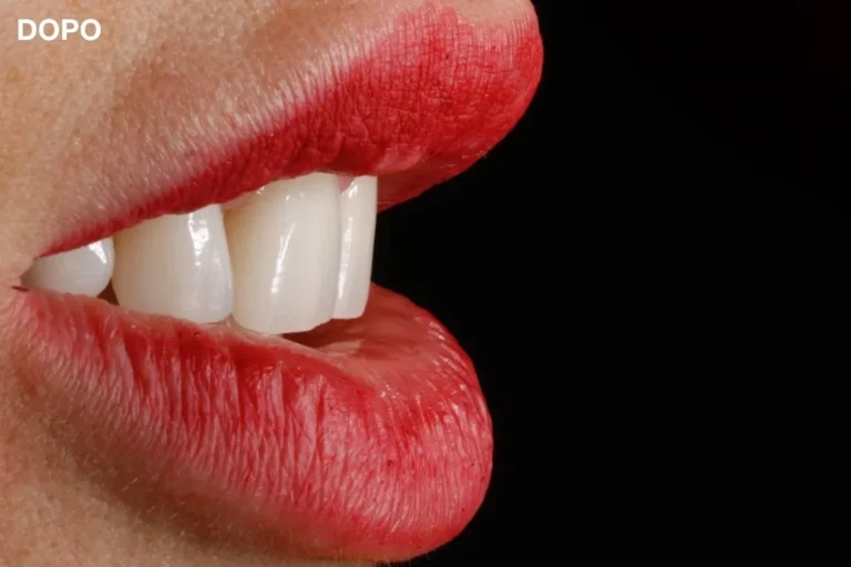 Denti prima e dopo 14 denti prima e dopo