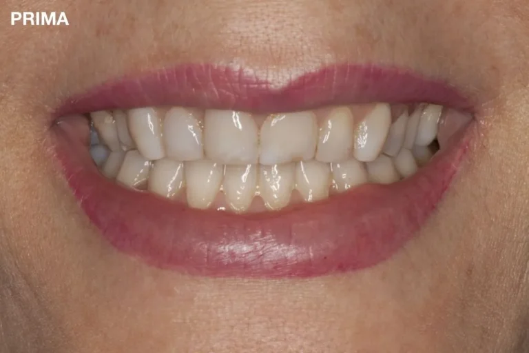 Denti prima e dopo 15 denti prima e dopo