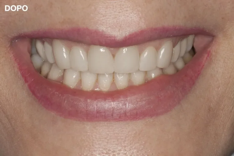 Denti prima e dopo 16 denti prima e dopo