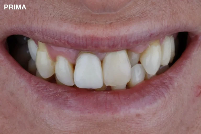 Denti prima e dopo 17 denti prima e dopo