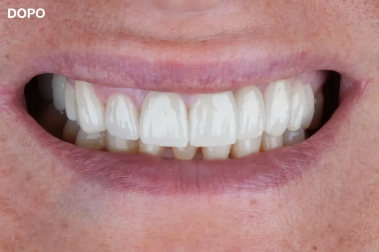 Denti prima e dopo 18 denti prima e dopo