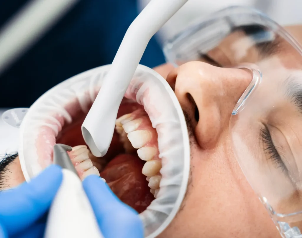 Pulizia dentale con Airflow: vantaggi rispetto agli ultrasuoni 1 pulizia dentale con Airflow