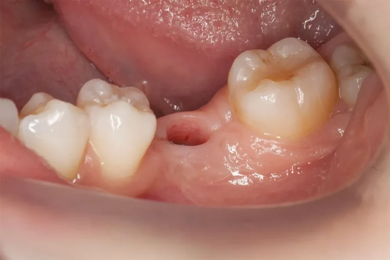 Denti prima e dopo 41 denti prima e dopo