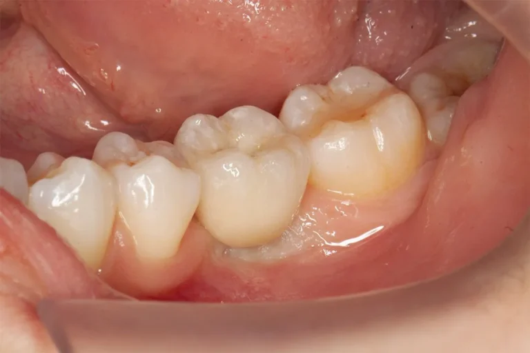 Denti prima e dopo 42 denti prima e dopo