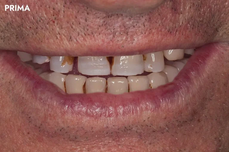Denti prima e dopo 43 denti prima e dopo