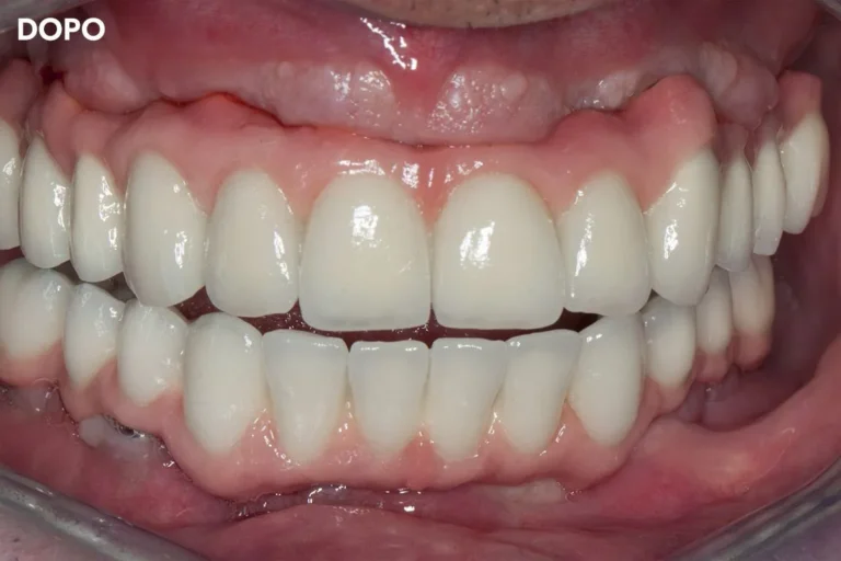 Denti prima e dopo 44 denti prima e dopo