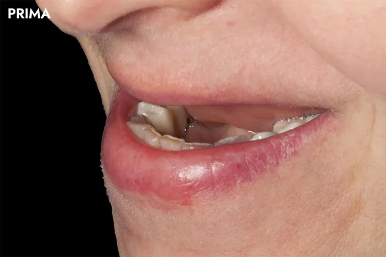 Denti prima e dopo 45 denti prima e dopo