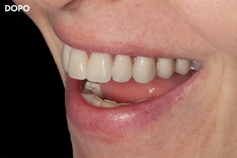 Denti prima e dopo 46 denti prima e dopo