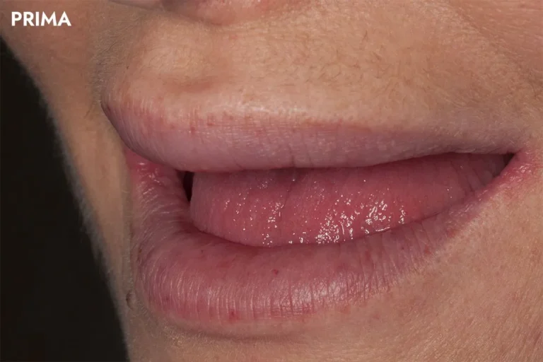 Denti prima e dopo 47 denti prima e dopo