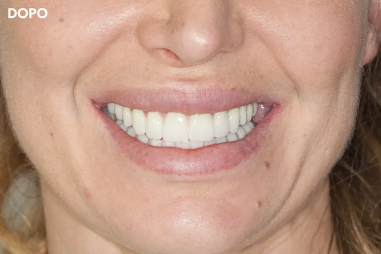 Denti prima e dopo 48 denti prima e dopo