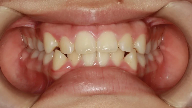 Denti prima e dopo 31 denti prima e dopo