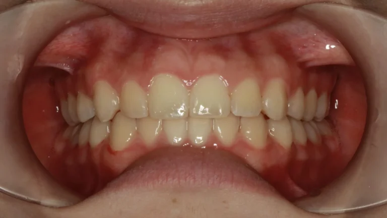 Denti prima e dopo 32 denti prima e dopo