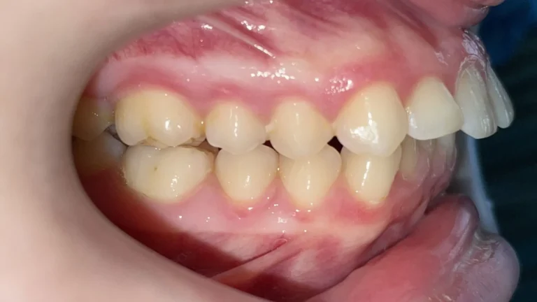 Denti prima e dopo 35 denti prima e dopo