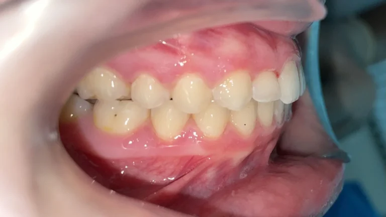 Denti prima e dopo 36 denti prima e dopo