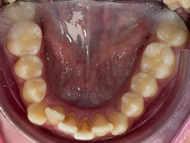 Denti prima e dopo 37 denti prima e dopo