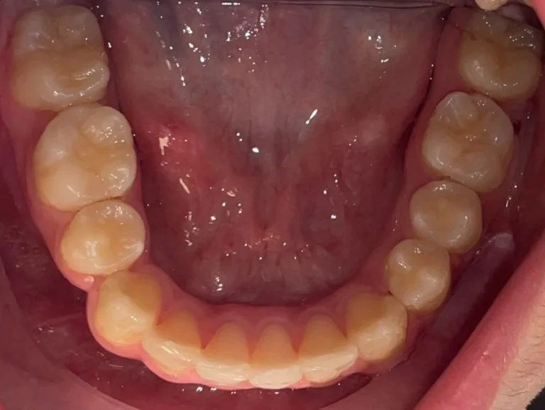 Denti prima e dopo 38 denti prima e dopo
