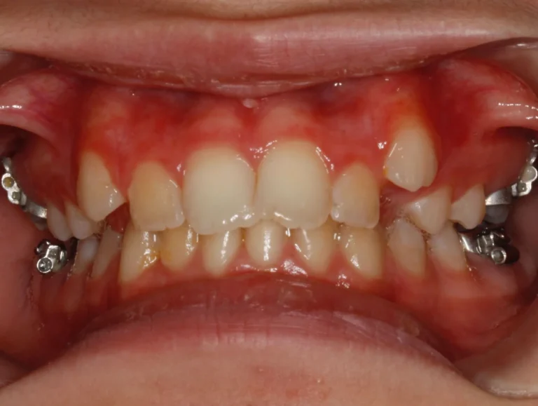 Denti prima e dopo 39 denti prima e dopo