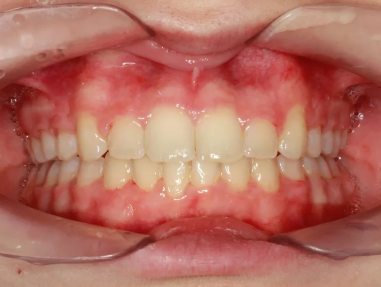 Denti prima e dopo 40 denti prima e dopo