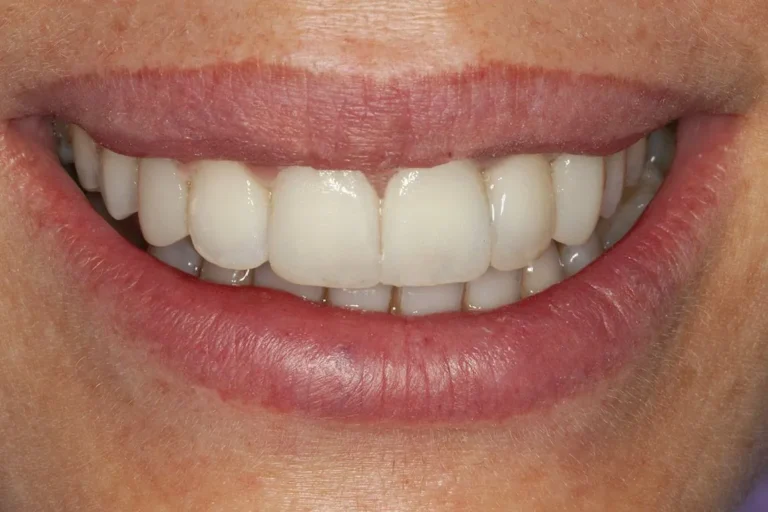 Denti prima e dopo 49 denti prima e dopo