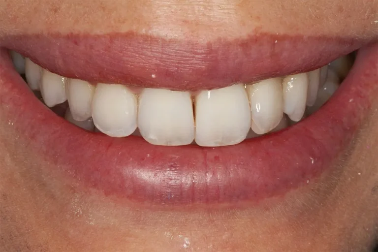 Denti prima e dopo 50 denti prima e dopo