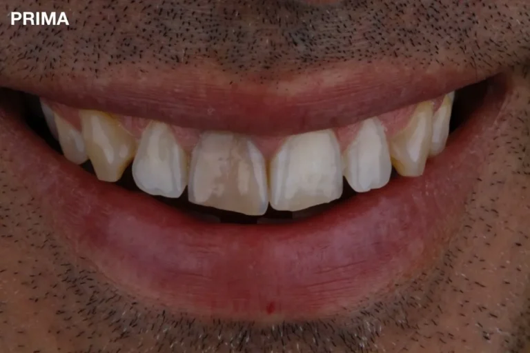 Denti prima e dopo 51 denti prima e dopo